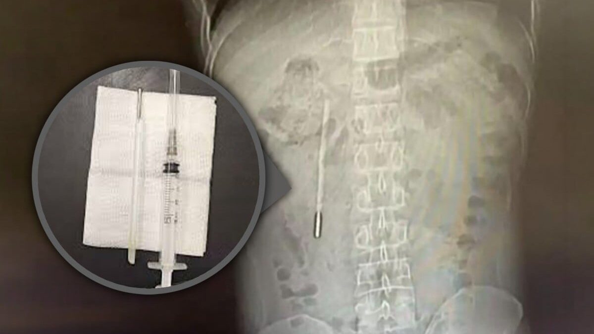 Đi viện vì đau dạ dày, người đàn ông bất ngờ phát hiện chiếc nhiệt kế thủy ngân nằm trong bụng suốt hai mươi năm